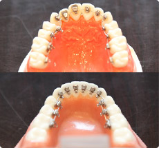 見えない矯正治療の治療イメージ